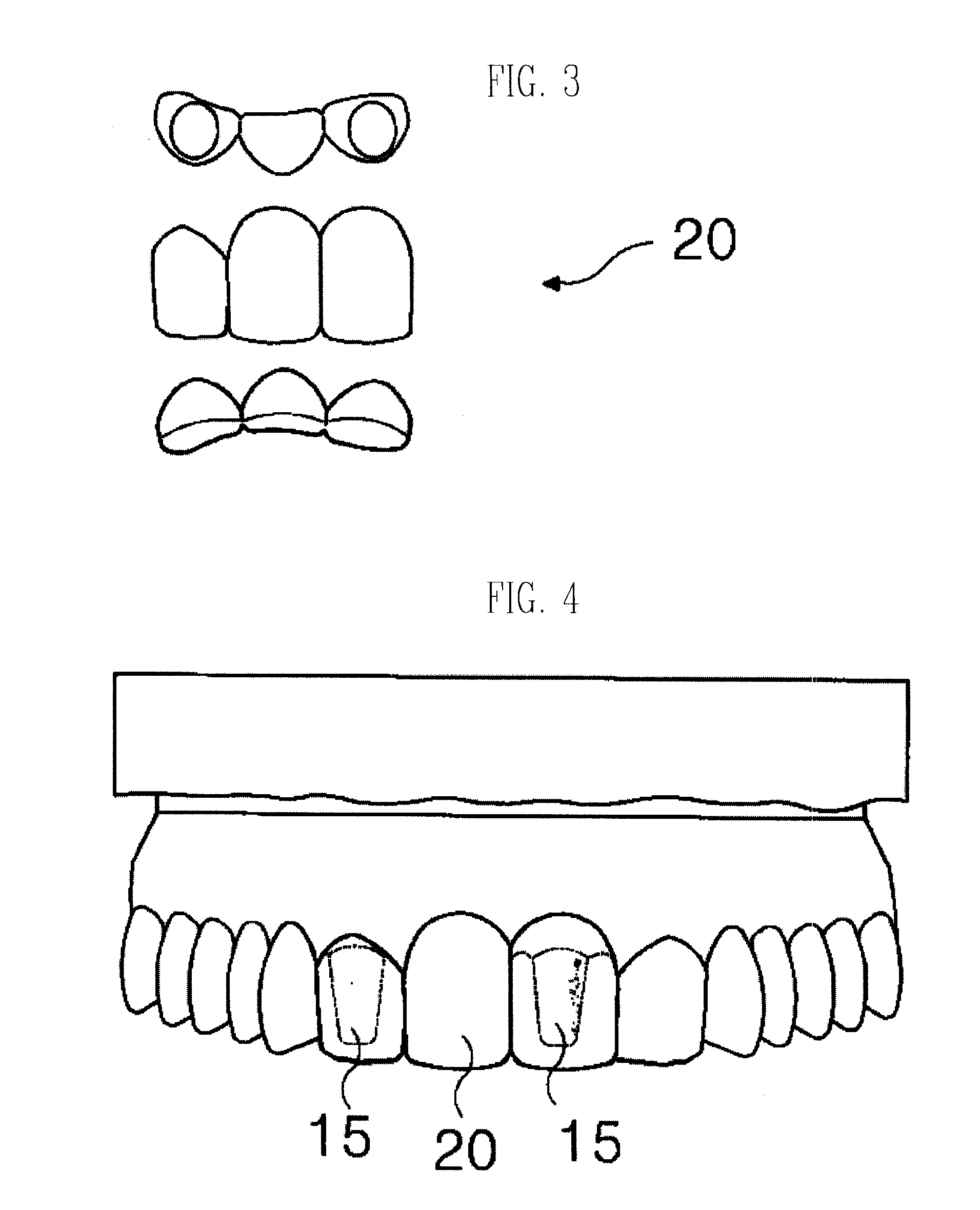 Temporary tooth bridge using veneer shell plate