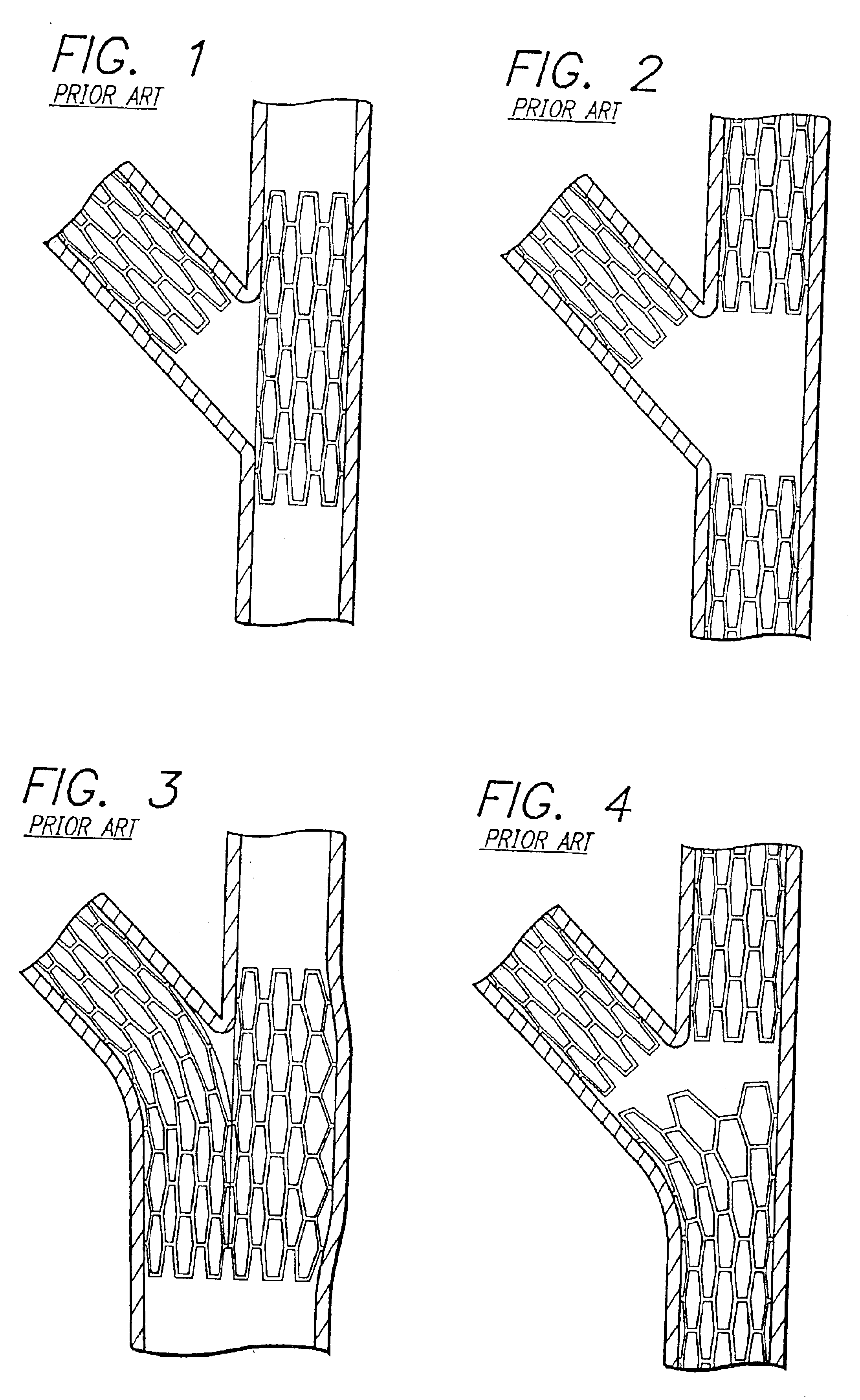 Stent and catheter assembly and method for treating bifurcations