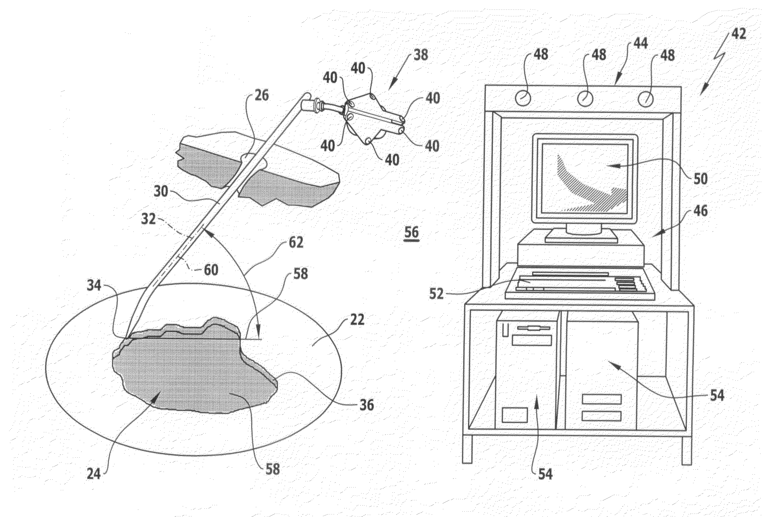 Method for treating a cartilage defect, surgical instrumentation and surgical navigation system