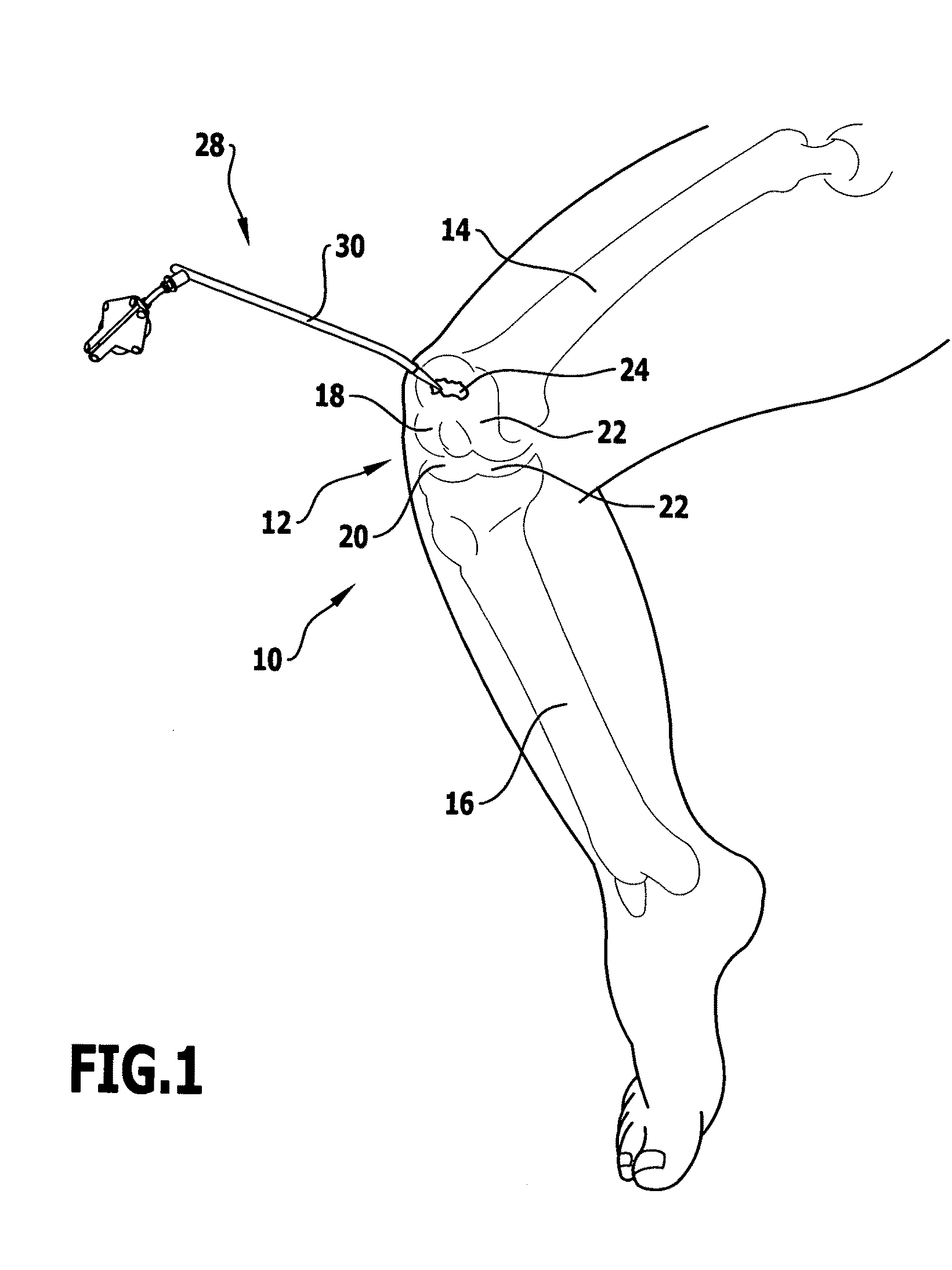 Method for treating a cartilage defect, surgical instrumentation and surgical navigation system