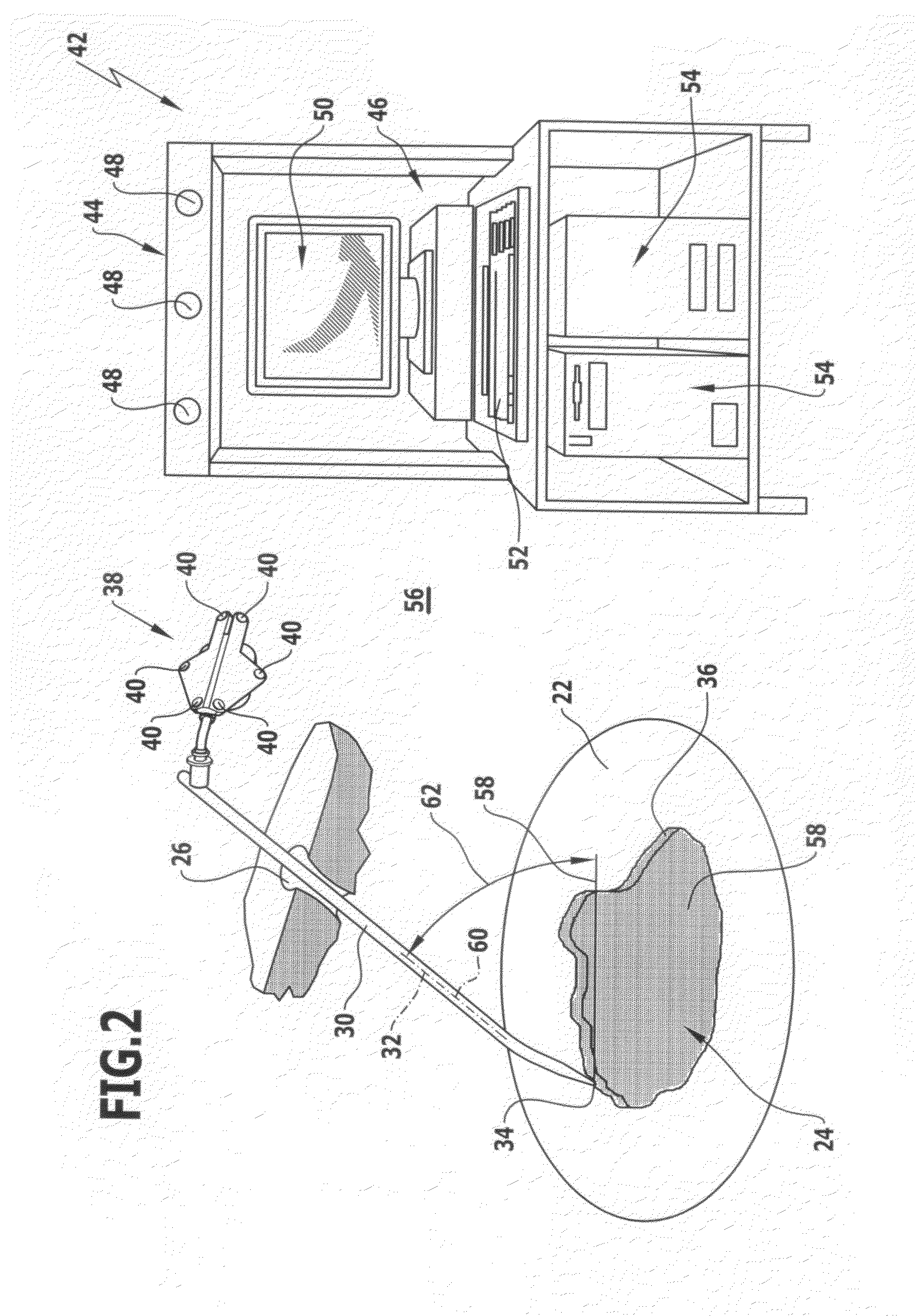 Method for treating a cartilage defect, surgical instrumentation and surgical navigation system