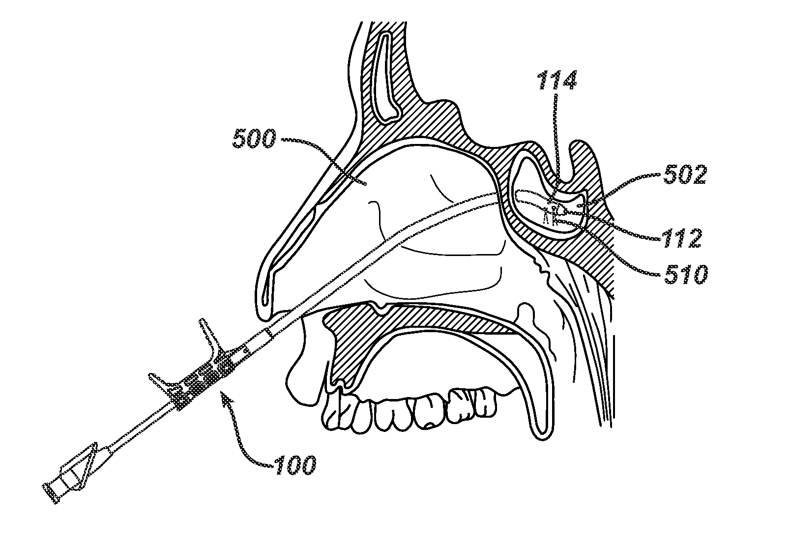 Devices and methods for transnasal irrigation or suctioning of the sinuses