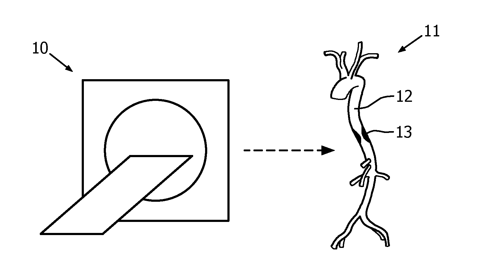 Stenosis therapy planning