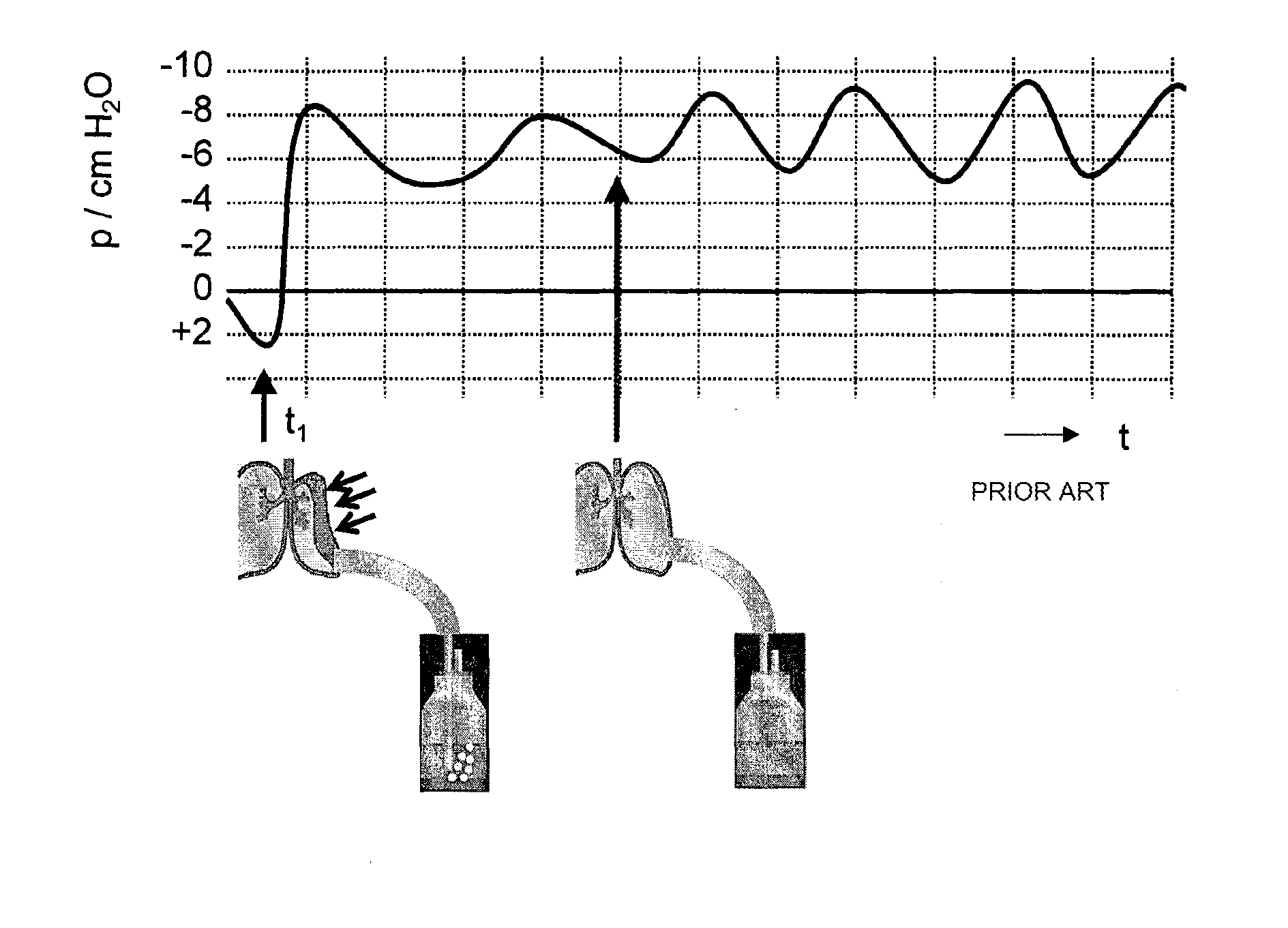 Thoracic Drainage Device Having Reduced Counter-Pressure