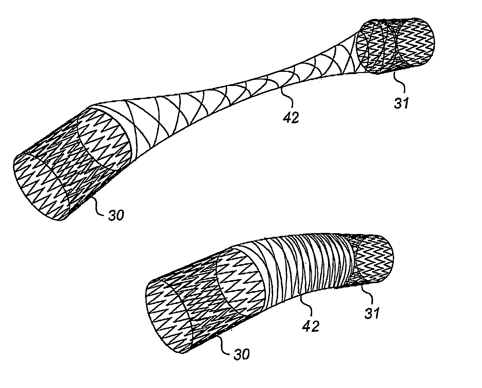 Method and device for treatment of mitral insufficiency