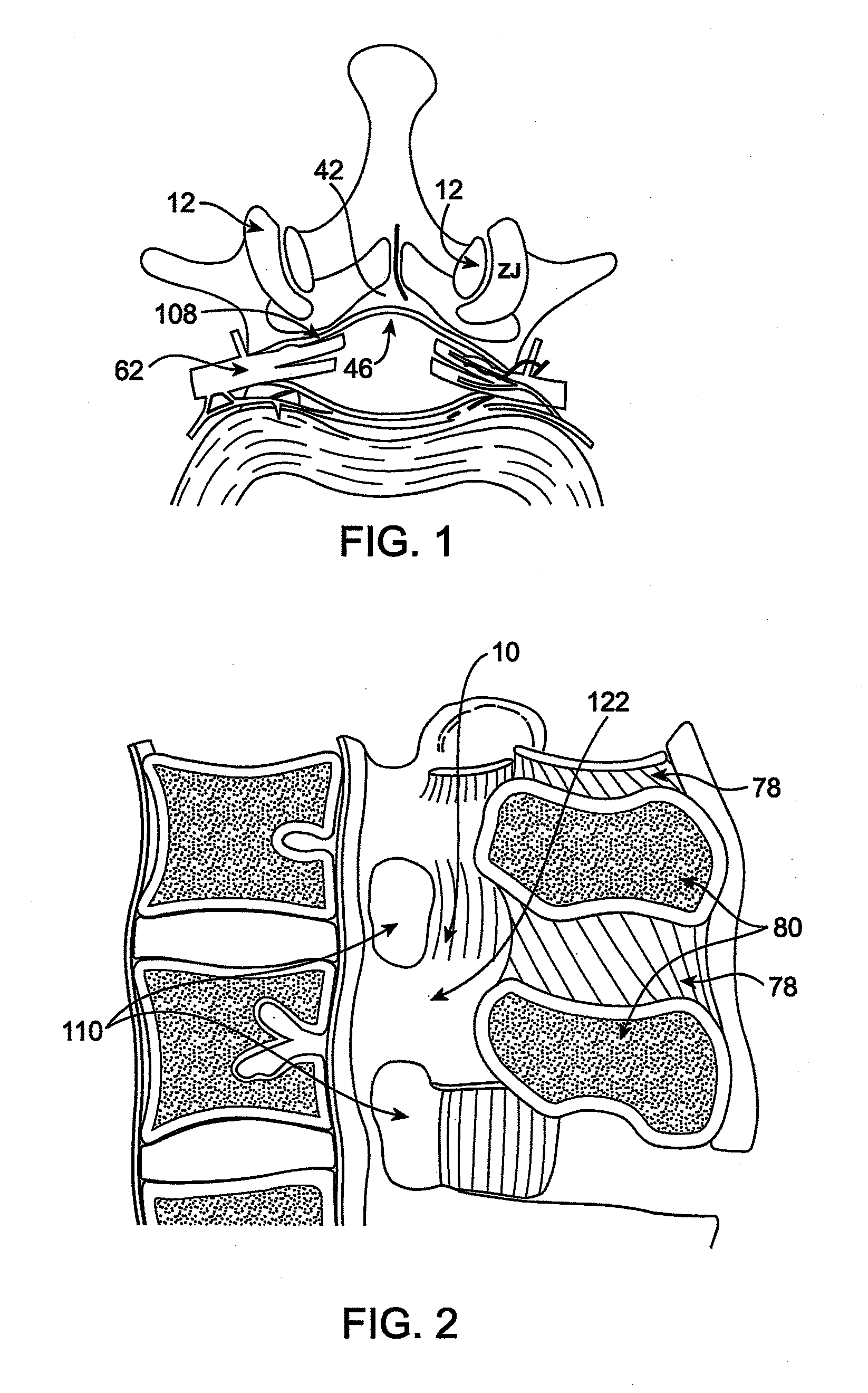 Devices and methods for tissue modification