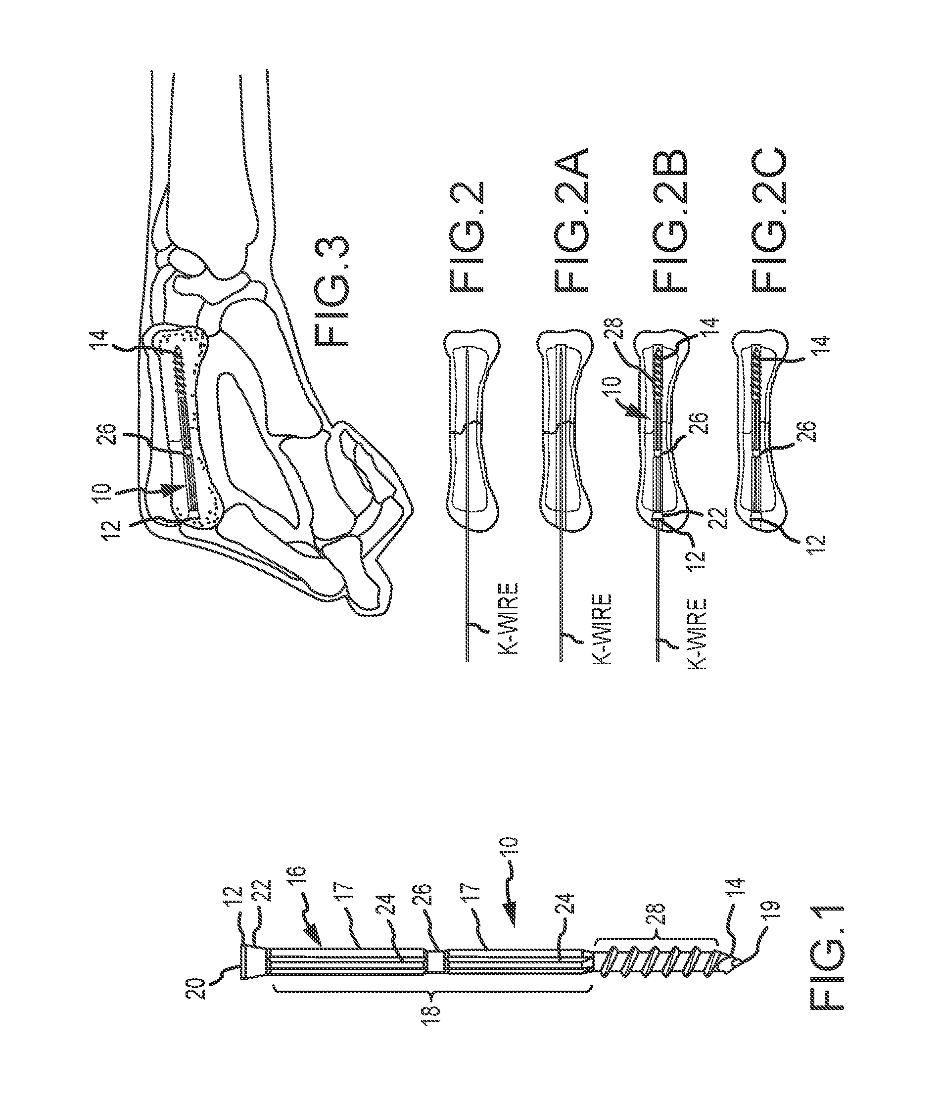 Metacarpal bone stabilization device