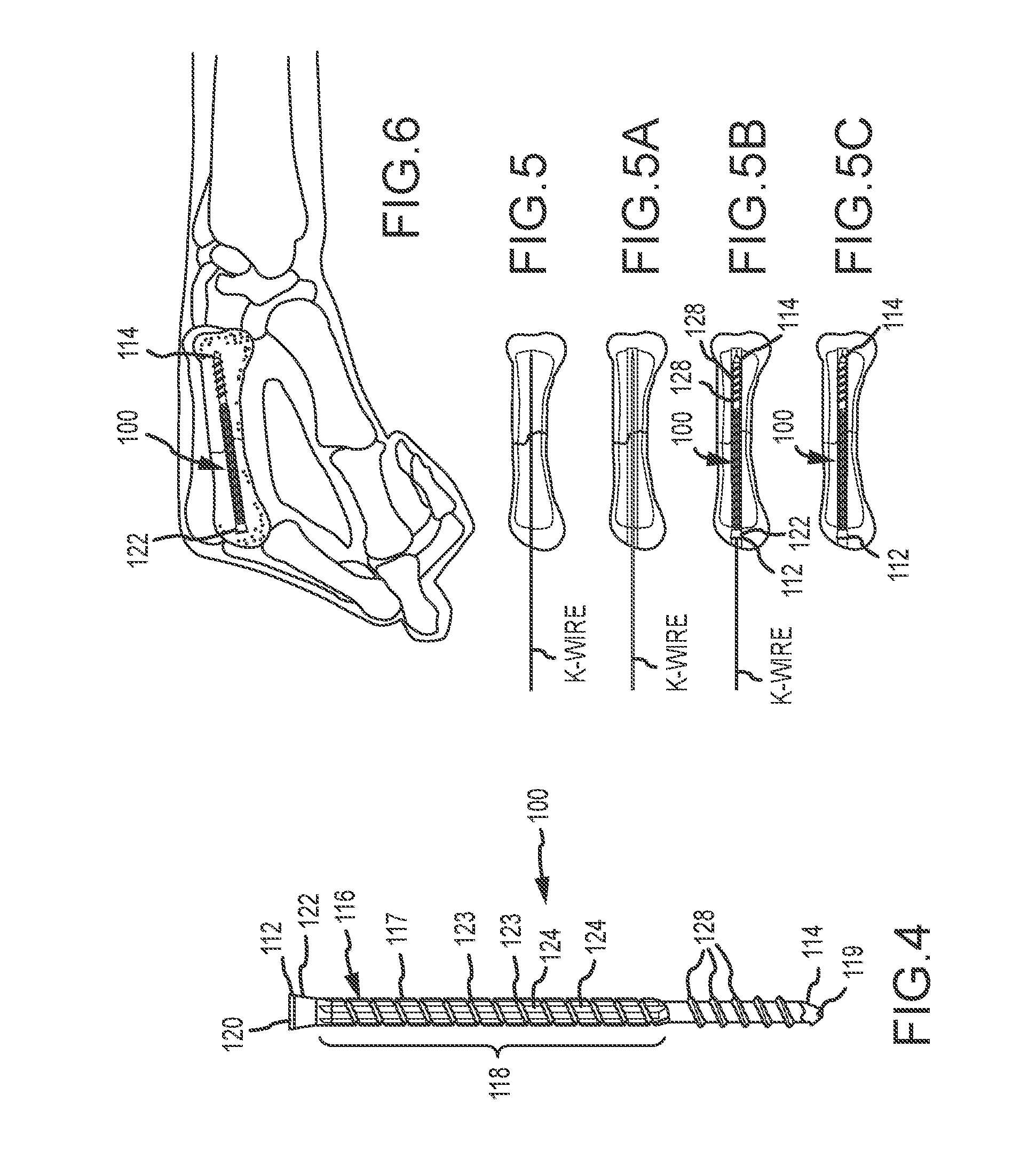 Metacarpal bone stabilization device