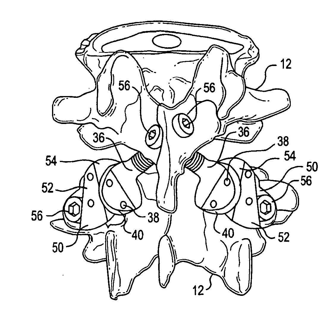 Crossbar spinal prosthesis having a modular design and related implantation methods