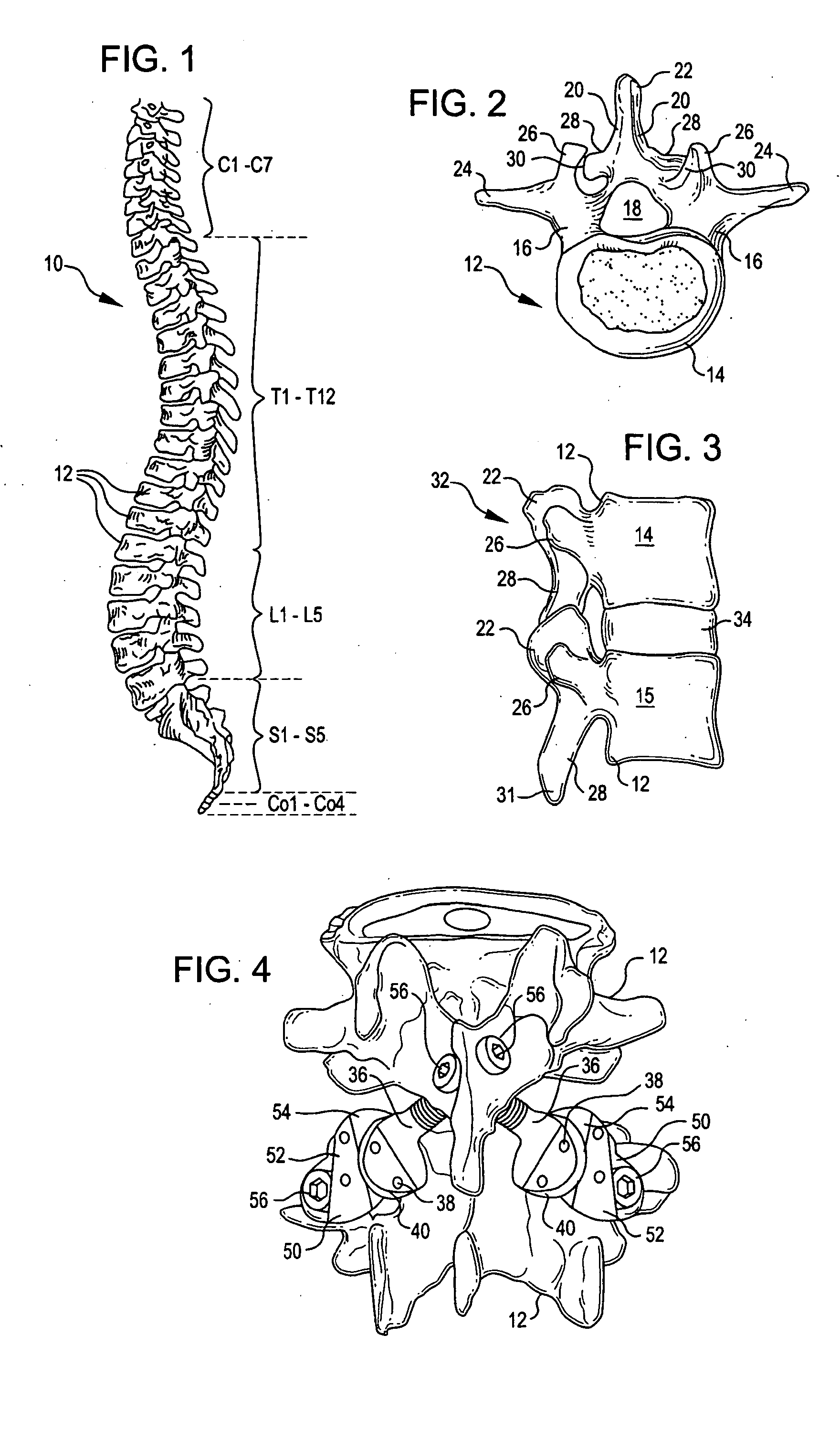 Crossbar spinal prosthesis having a modular design and related implantation methods