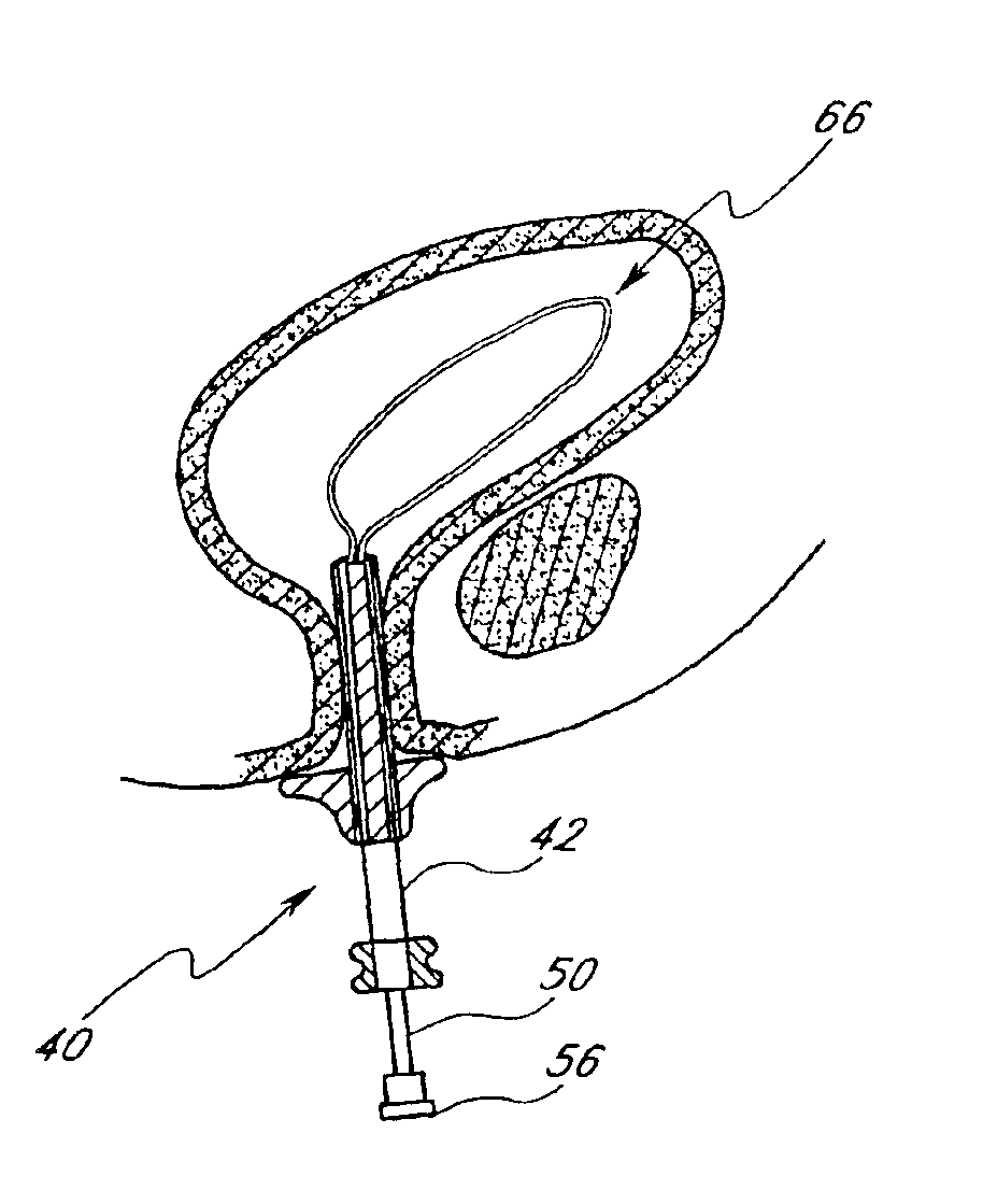 High vapor pressure attenuation device