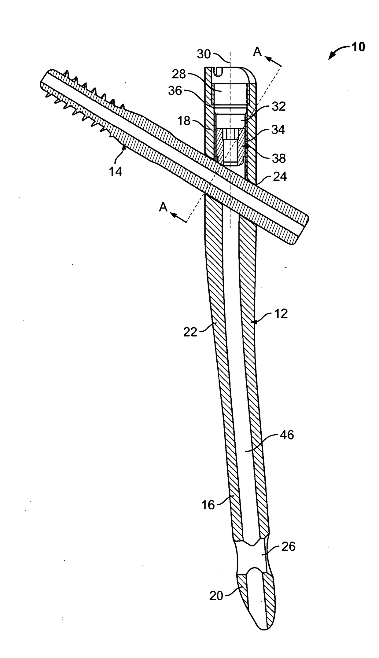 Implant system for bone fixation