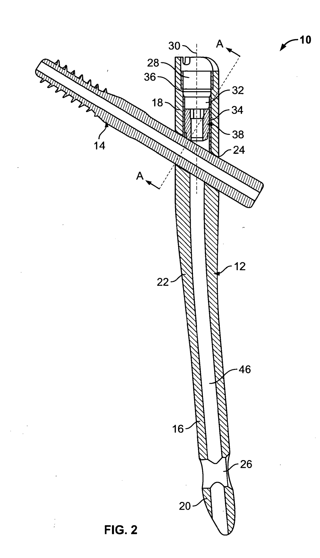 Implant system for bone fixation