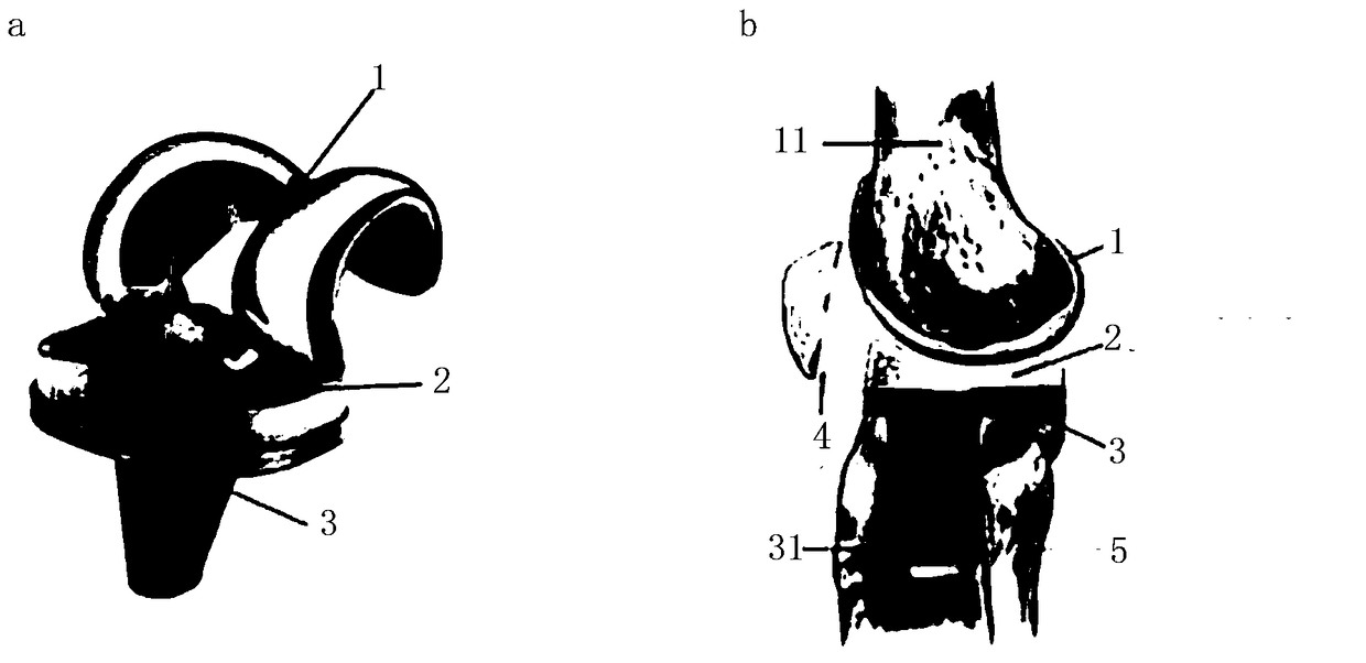 Design method of a customized artificial knee prosthesis