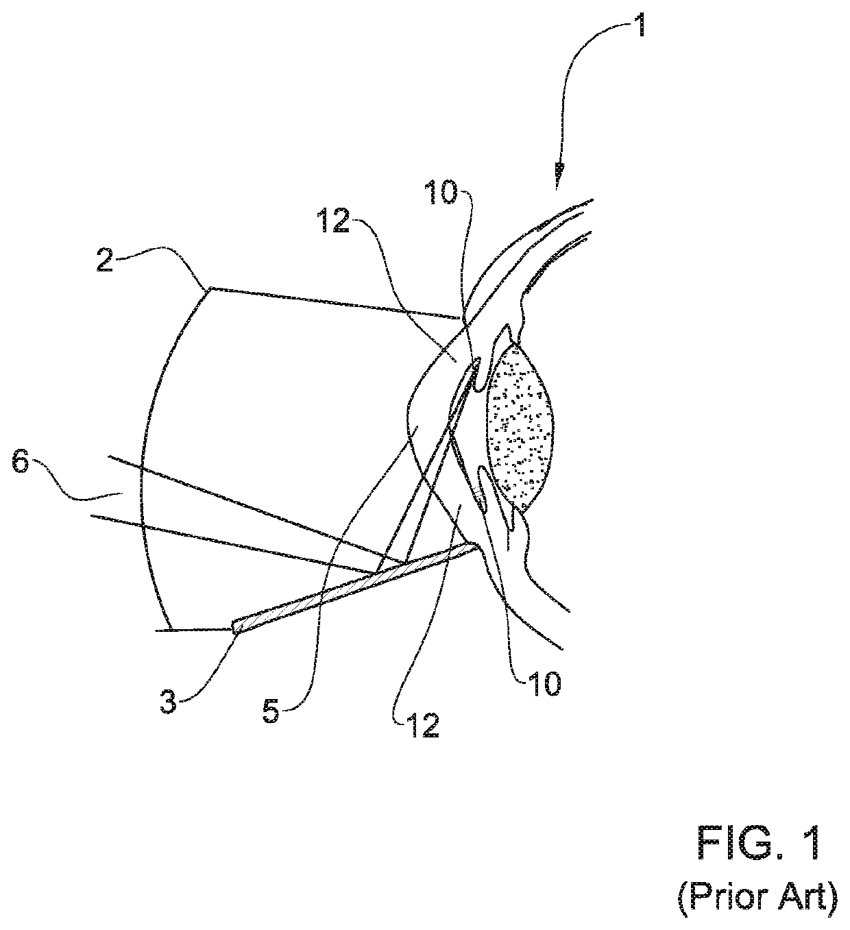 System and method for treating an eye