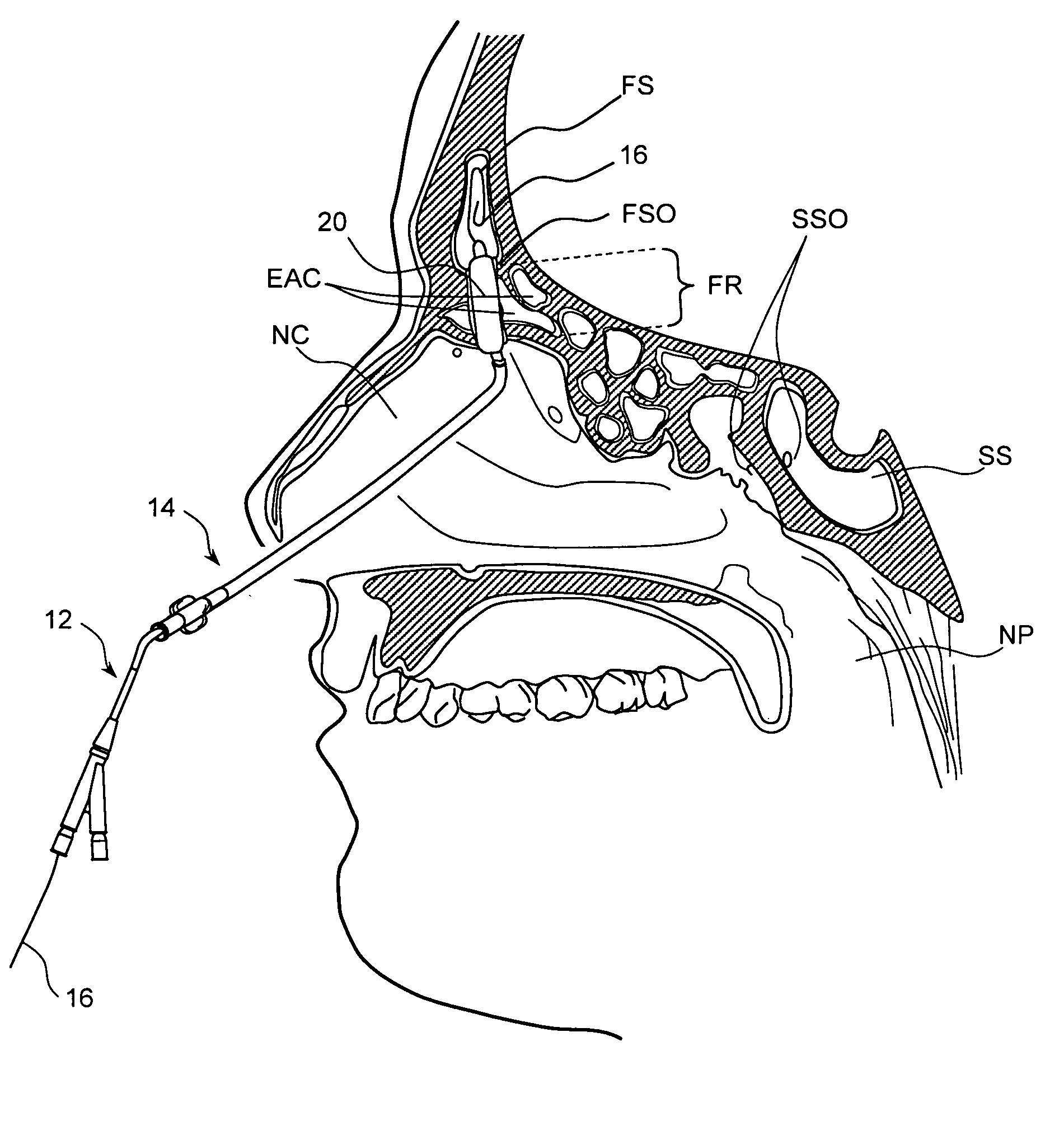 Devices, systems and methods useable for treating frontal sinusitis