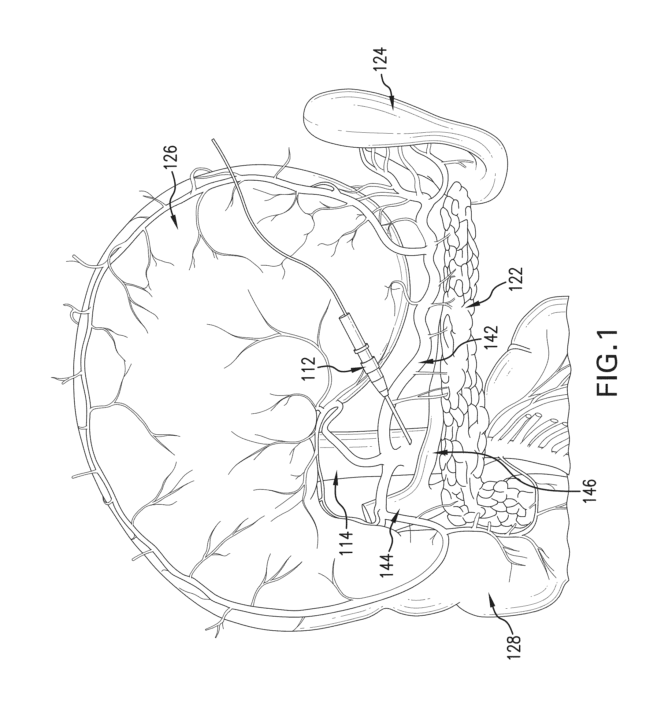 METHOD FOR REVERSING RECENT-ONSET TYPE 1 DIABETES (T1D) BY ADMINISTERING SUBSTANCE P (sP)