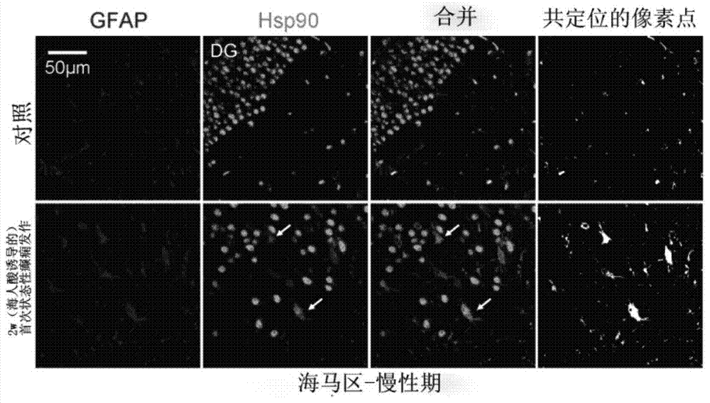 Application of 17-allylamine-17-demethoxygeldanamycin in preparation of medicine for treating epilepsy