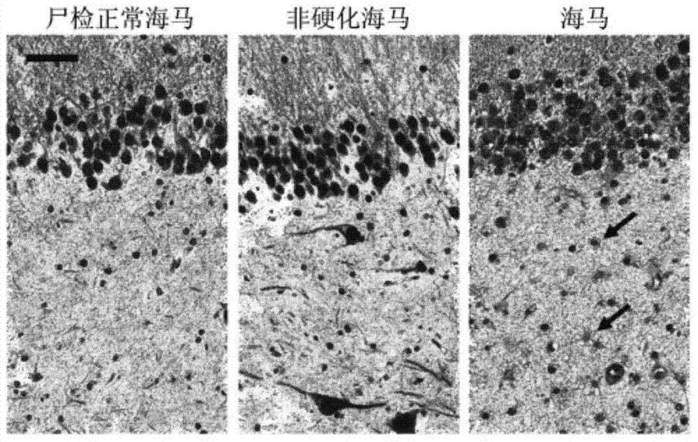 Application of 17-allylamine-17-demethoxygeldanamycin in preparation of medicine for treating epilepsy