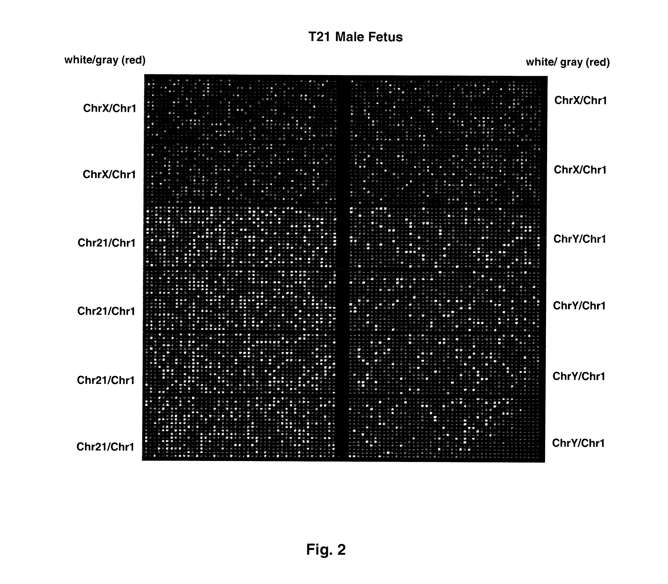 Direct Molecular Diagnosis of Fetal Aneuploidy