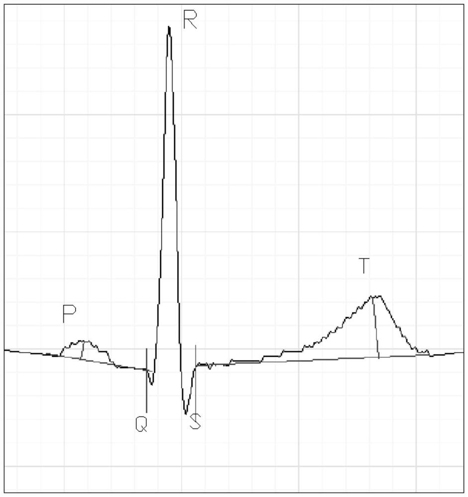 Dynamic electrocardiogram data analysis method