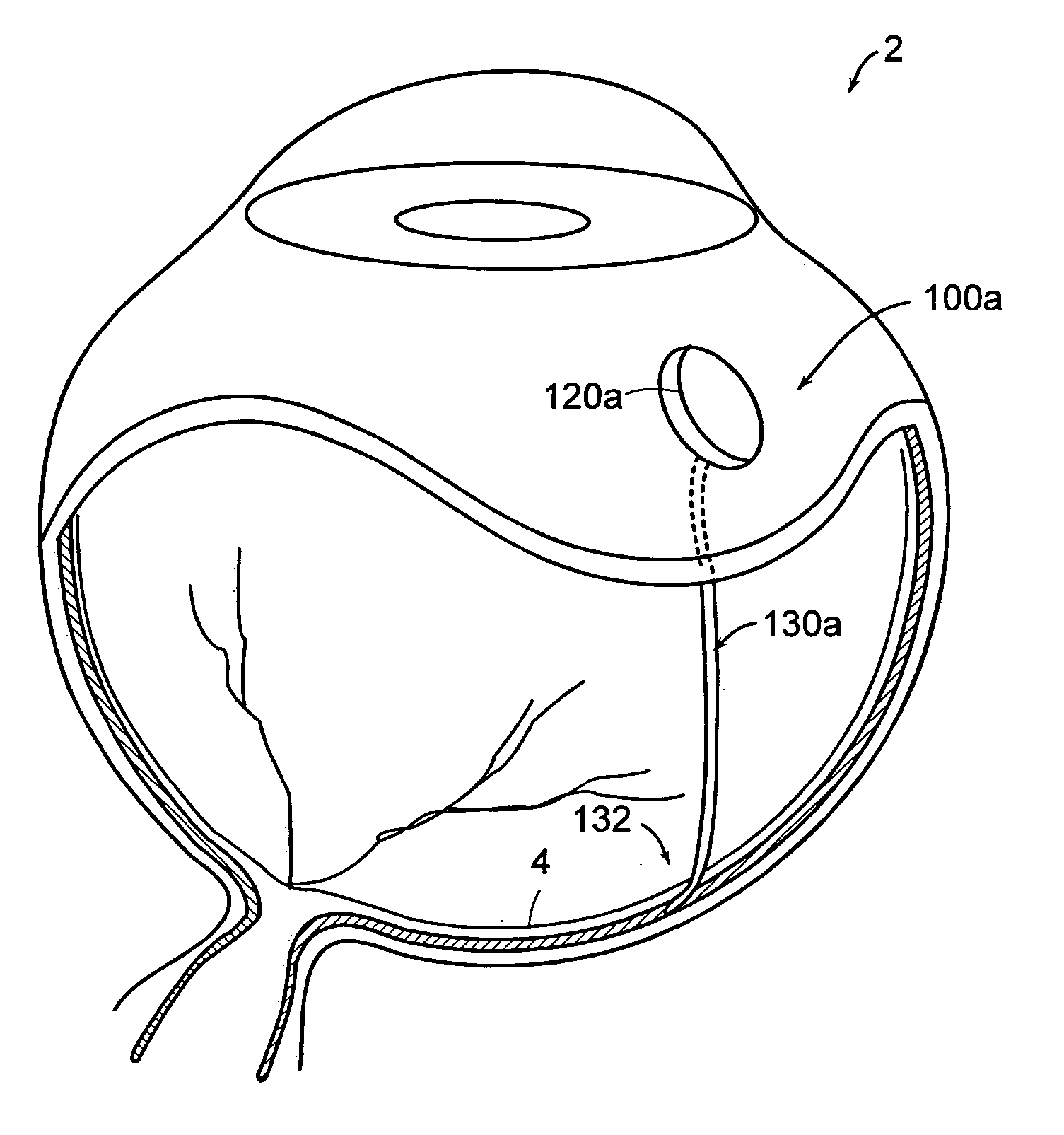 Reservoirs with subretinal cannula for subretinal drug delivery