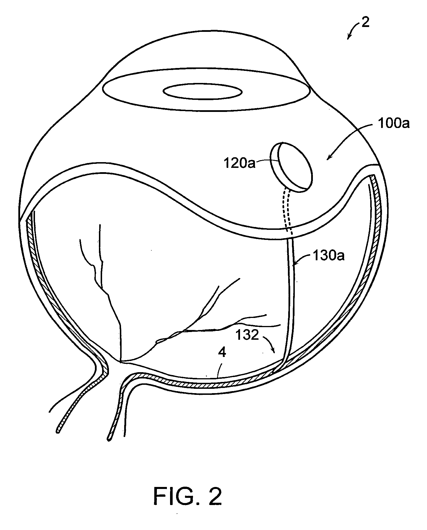 Reservoirs with subretinal cannula for subretinal drug delivery