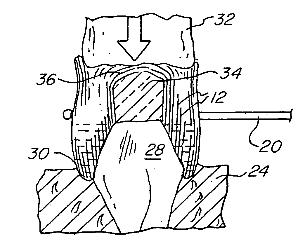 Conforming gingiva retraction compression cap and method of retracting tissue around a tooth