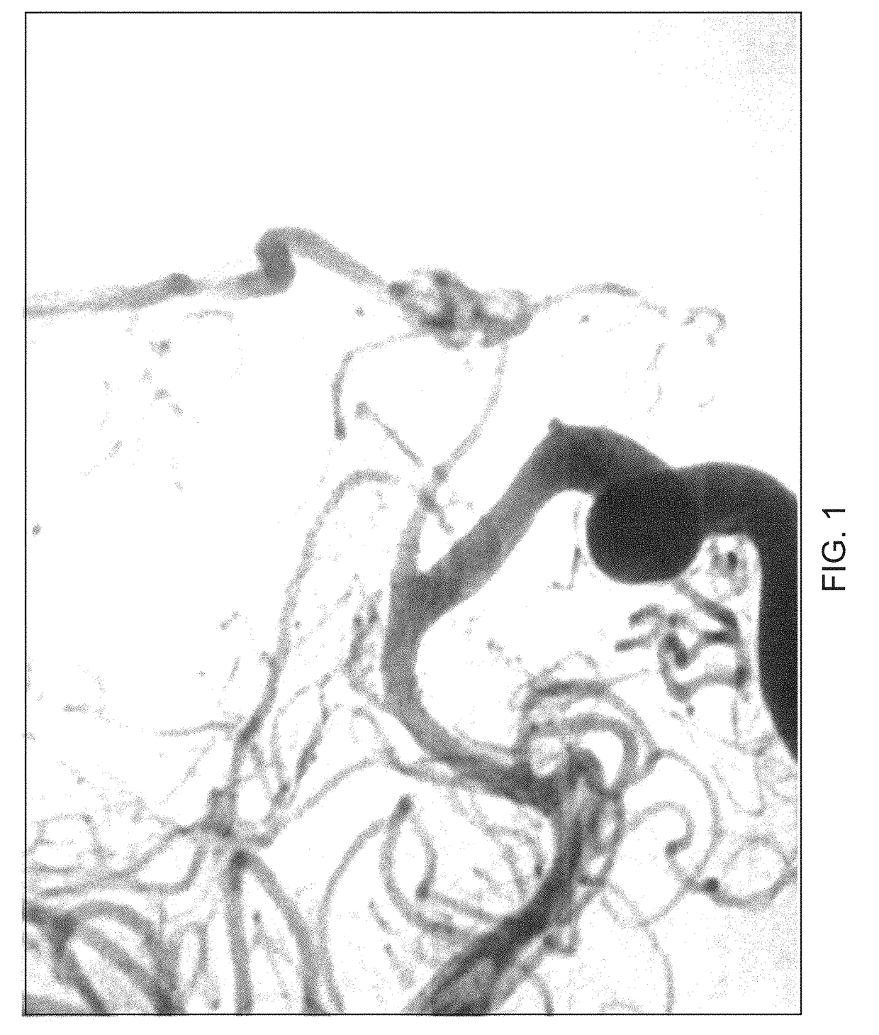 Treatment systems processes and devices addressing cerebral vasospasm/vasoconstriction