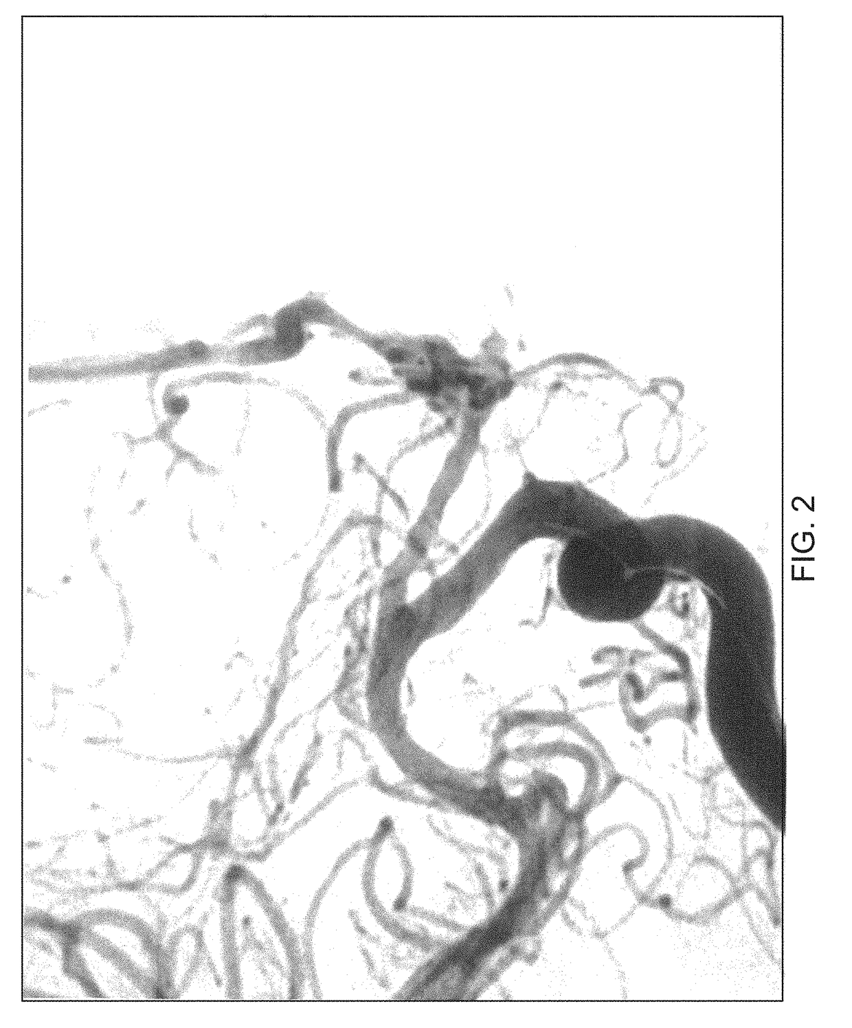 Treatment systems processes and devices addressing cerebral vasospasm/vasoconstriction