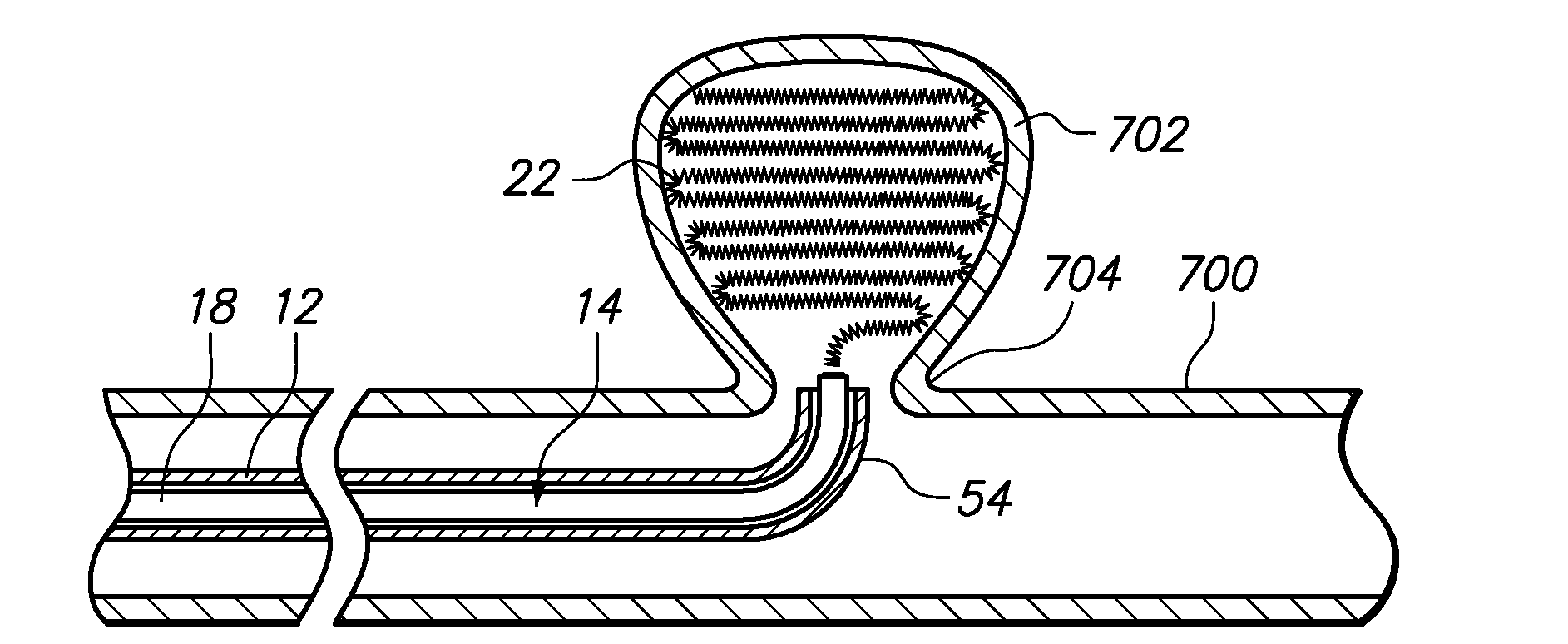 Medical implant detachment systems and methods