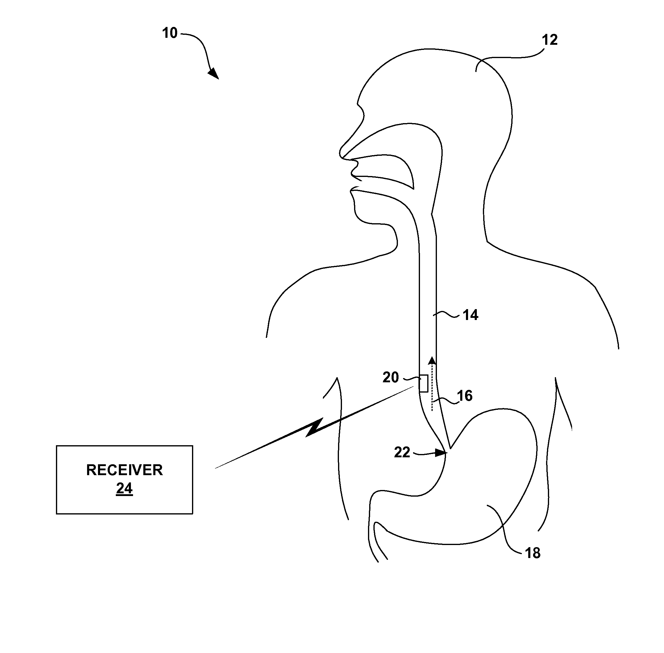 Monitoring fluid flow in the gastrointestinal tract