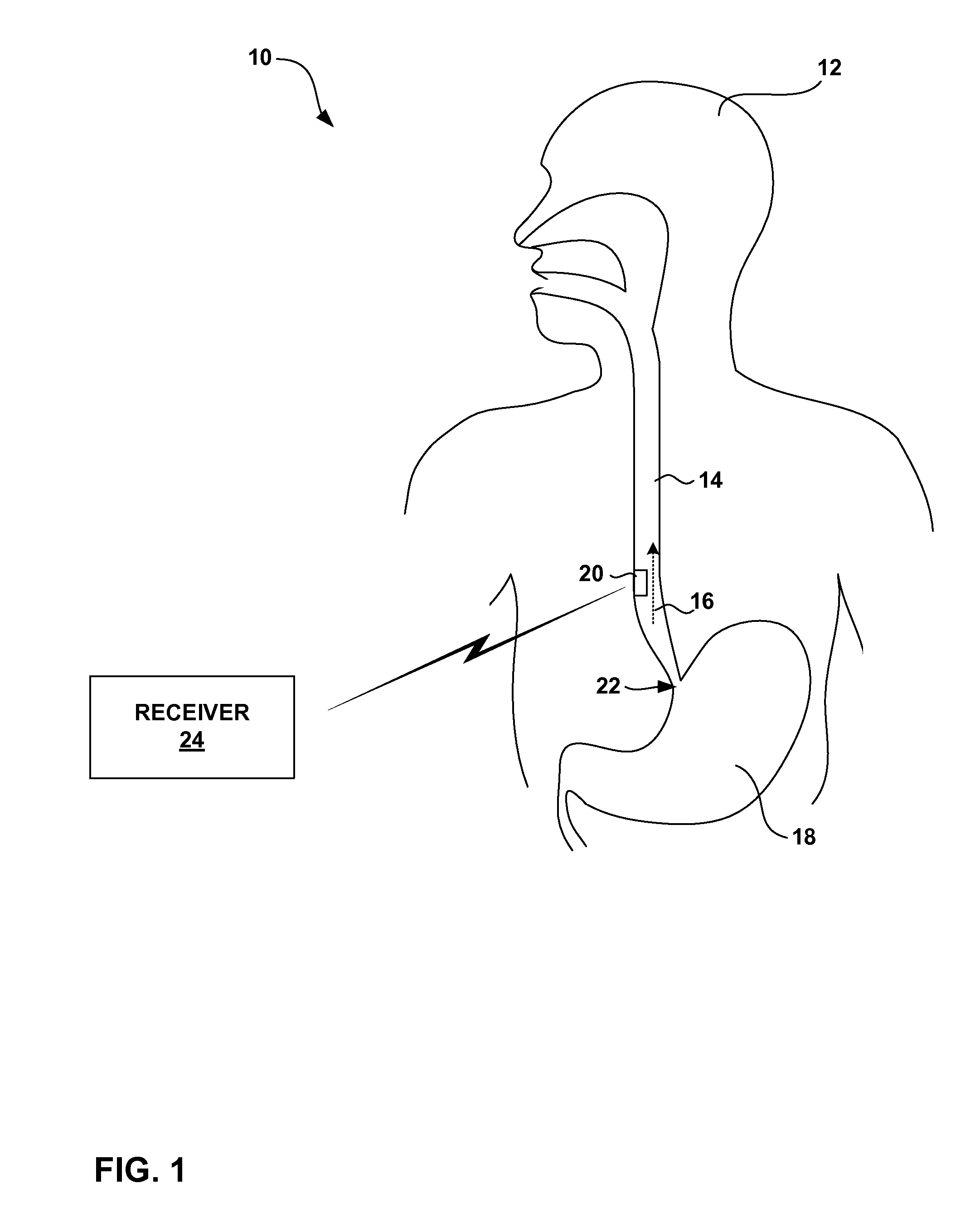 Monitoring fluid flow in the gastrointestinal tract