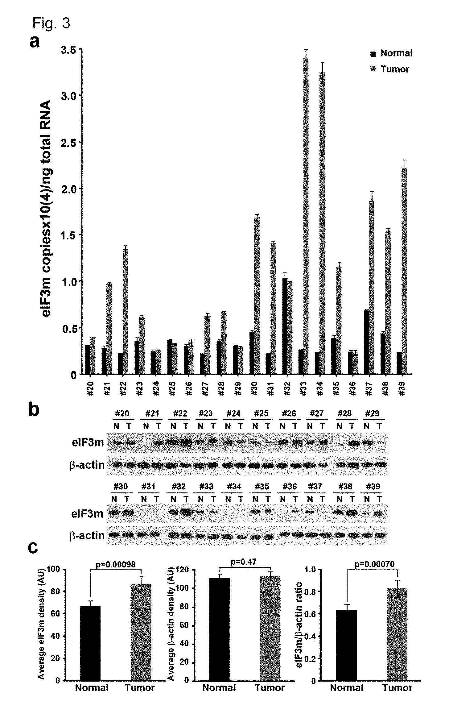 Use of eIF3m for the diagnosis and treatment of cancer