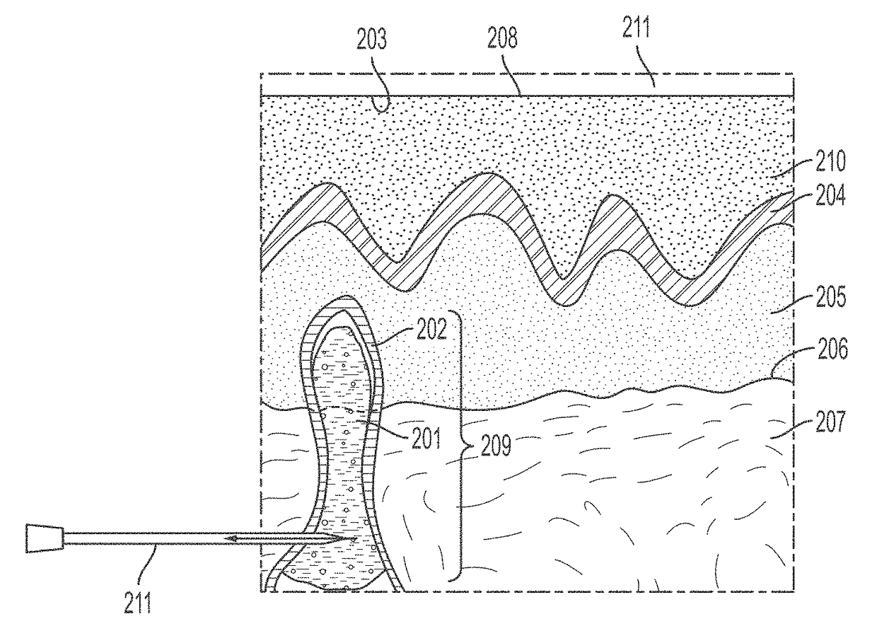 Methods and Compositions For The Treatment of Degenerate Bone