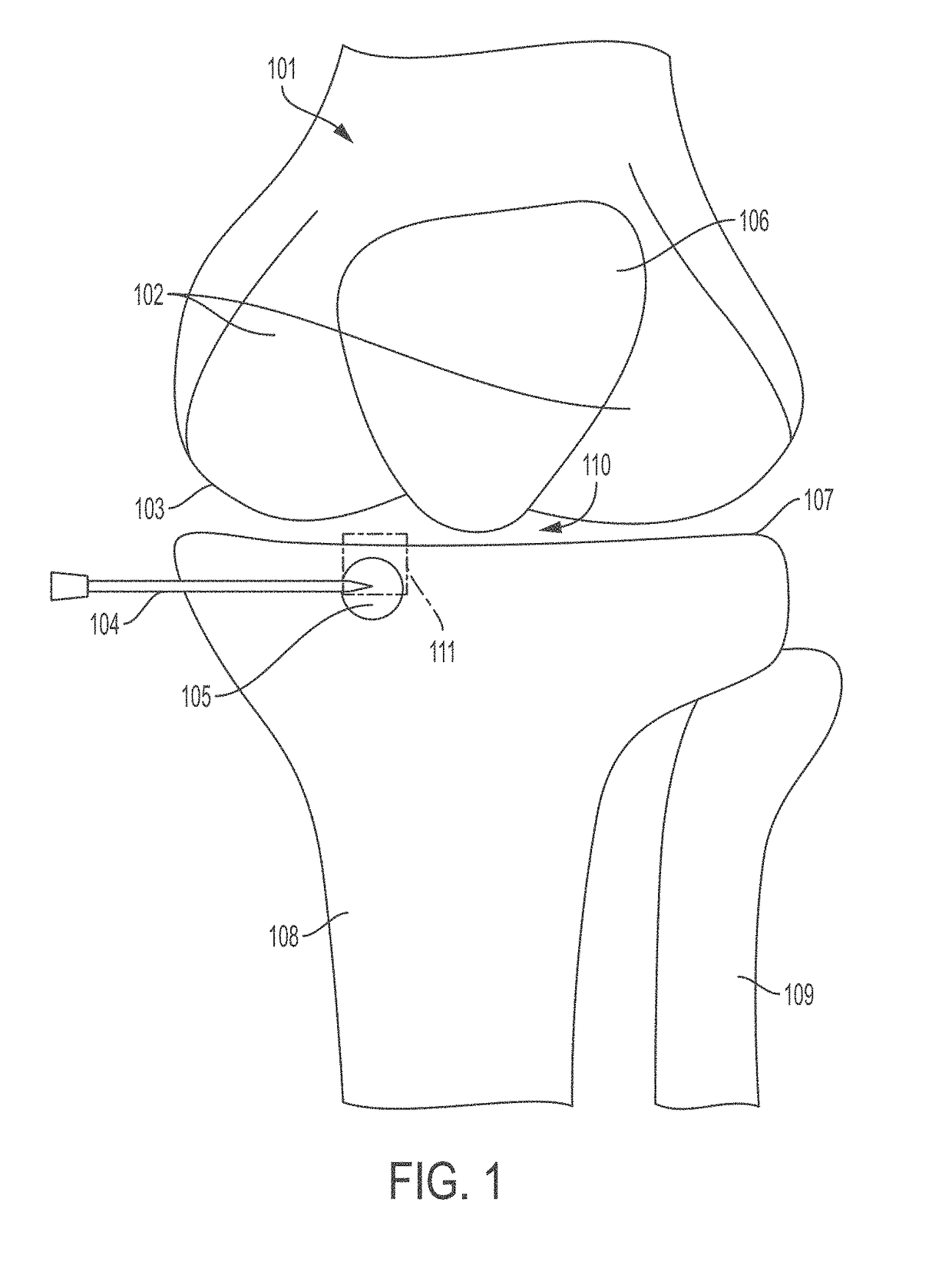 Methods and Compositions For The Treatment of Degenerate Bone