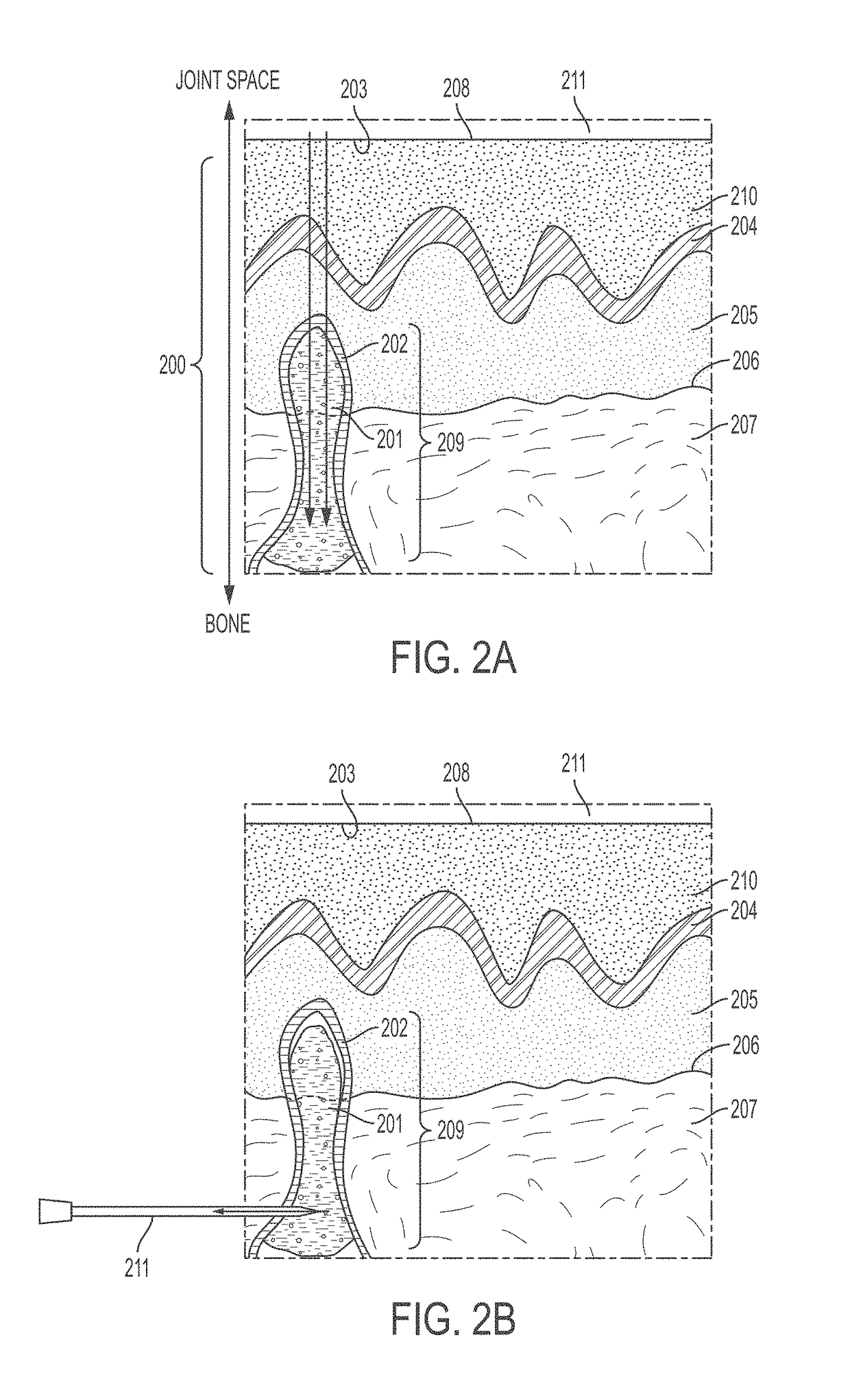 Methods and Compositions For The Treatment of Degenerate Bone