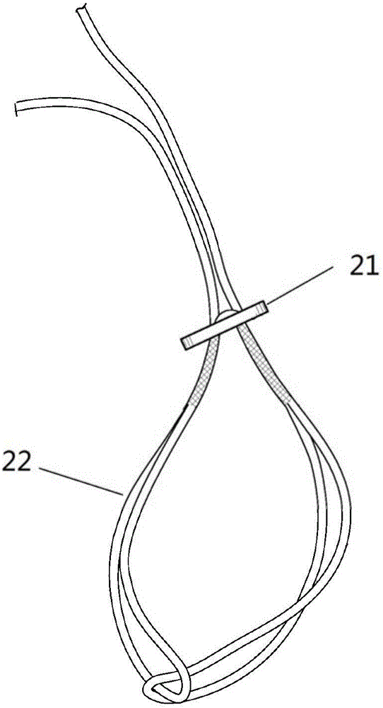 Fixing method for treating distal tibiofibular separation