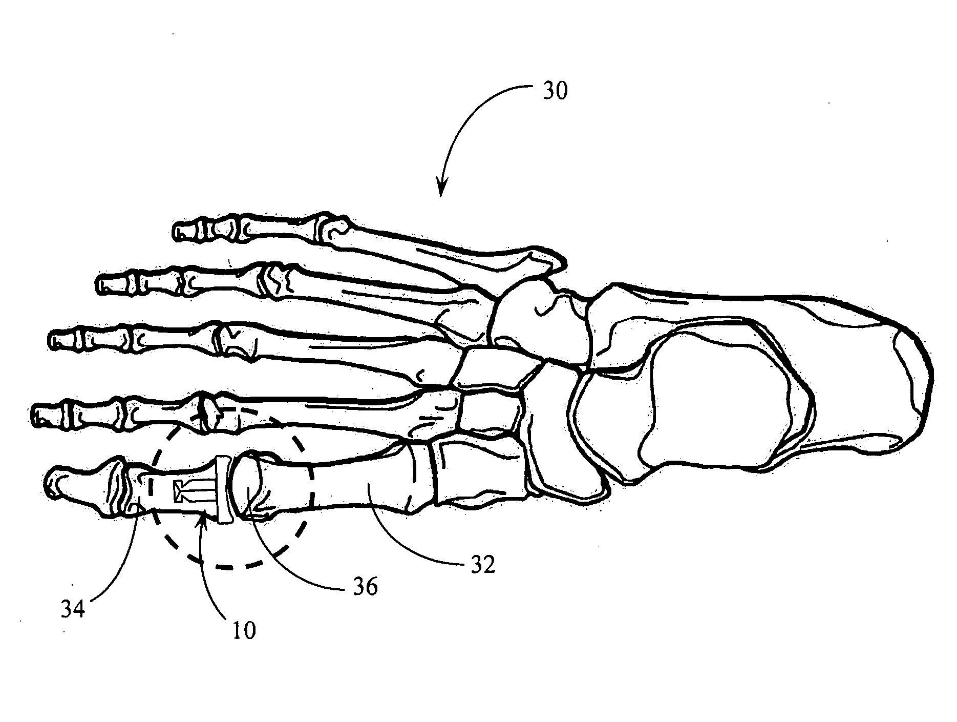 Hemi-implant for first metatarsophalangeal joint