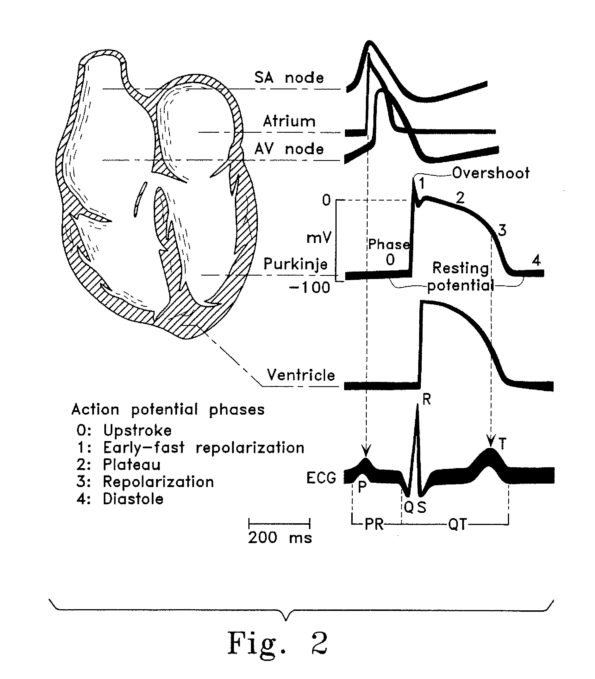 Method of treating arrhythmias