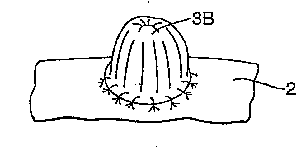 Abdominal reinforcement device