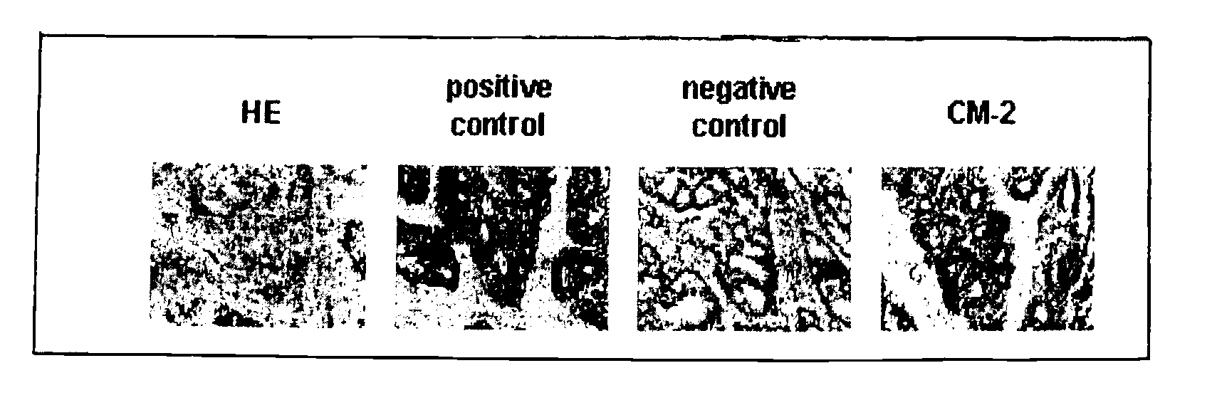 Neoplasm specific antibodies and uses thereof