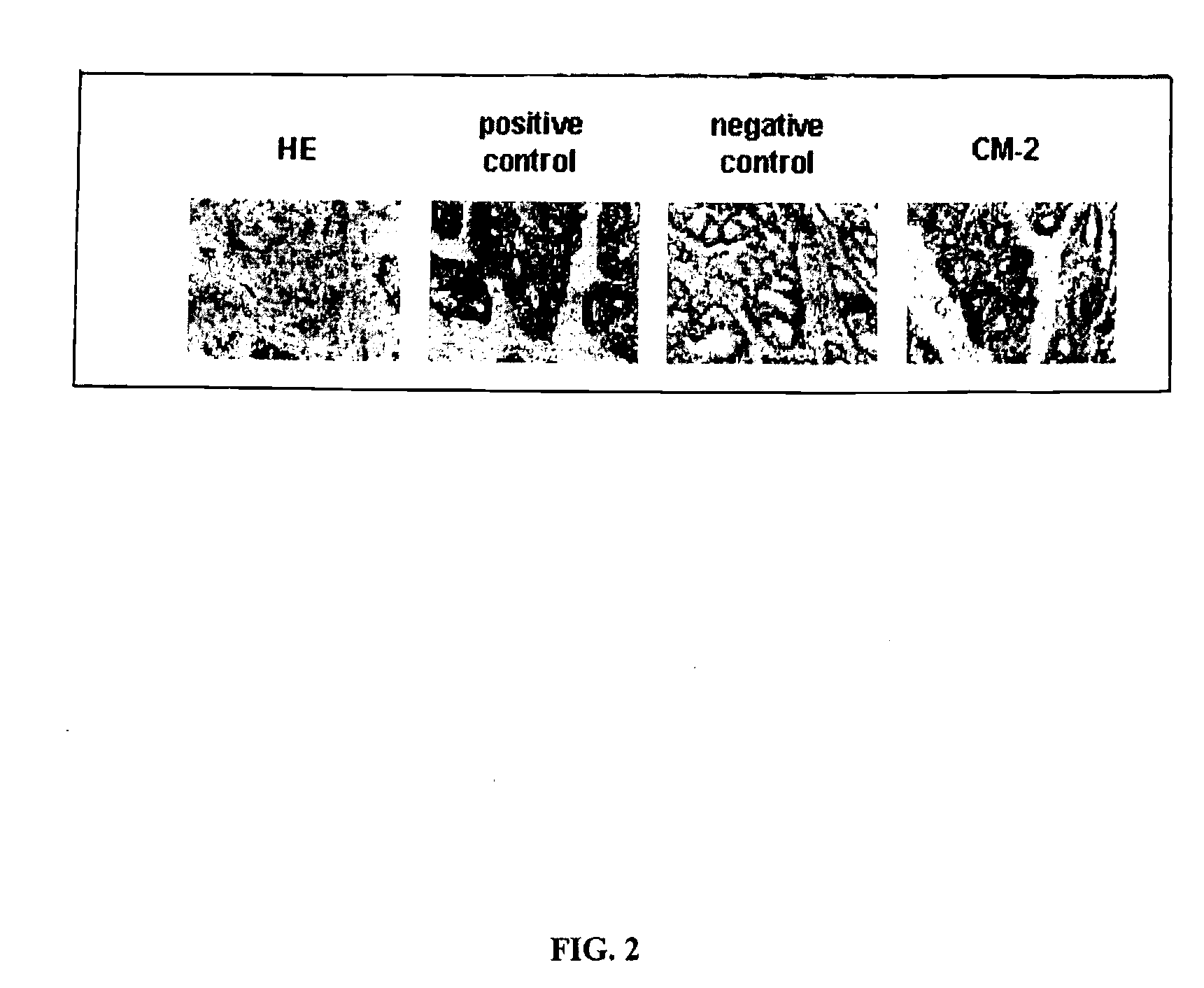 Neoplasm specific antibodies and uses thereof