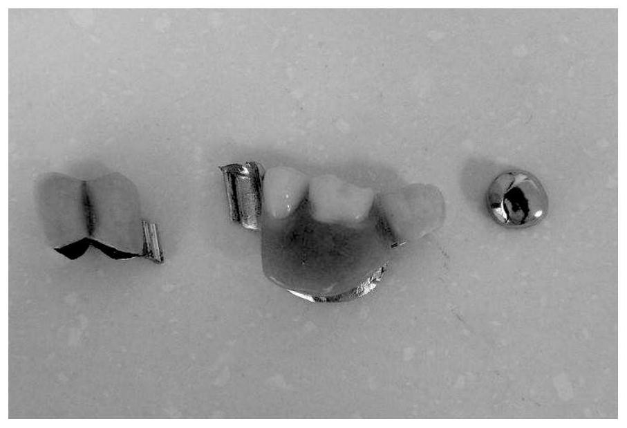 Bolt retention structure integrally formed with artificial crown and manufacturing method of matching bolt channel