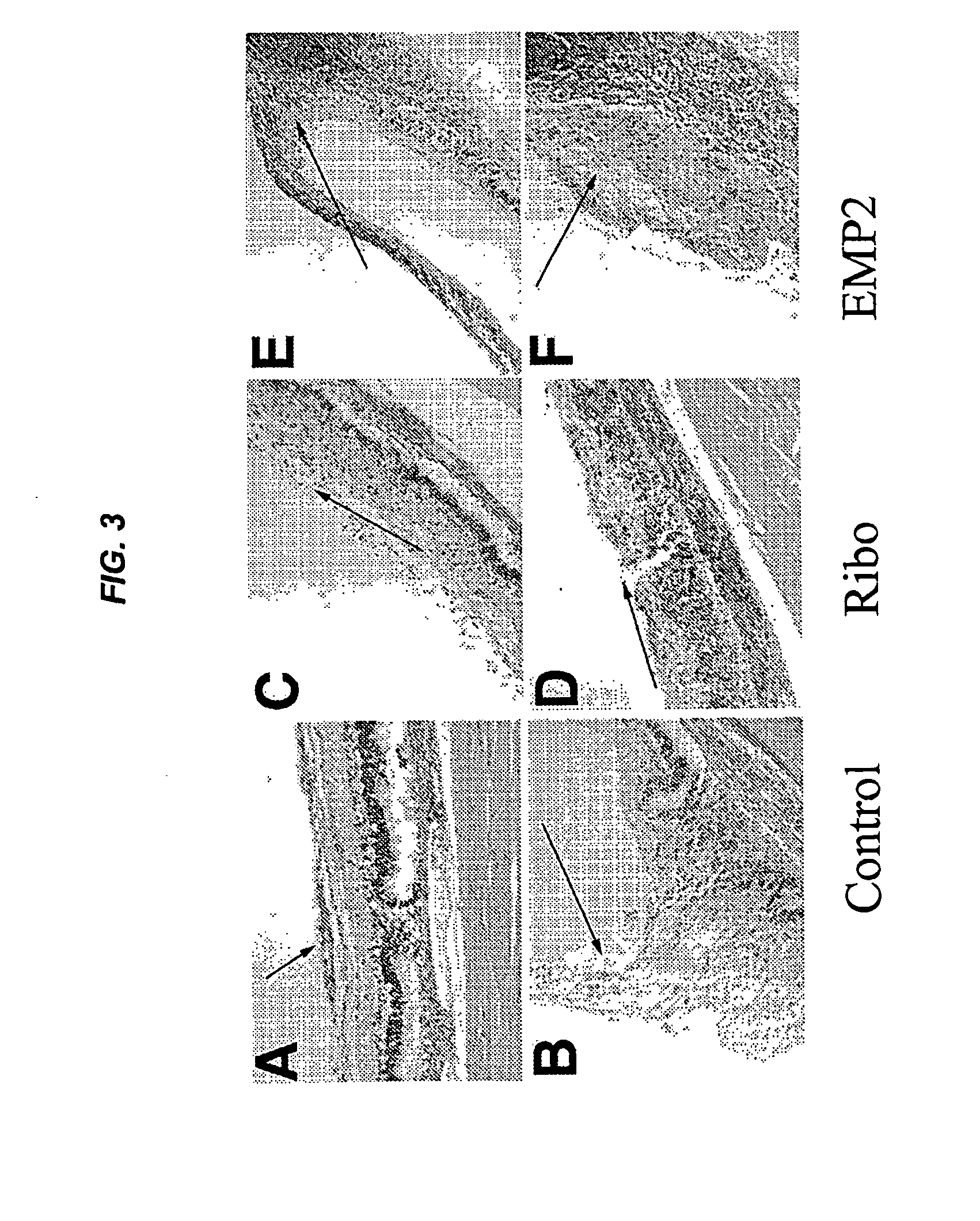 Epithelial membrane protein-2 (EMP2) and proliferative vitroretinopathy (PVR)