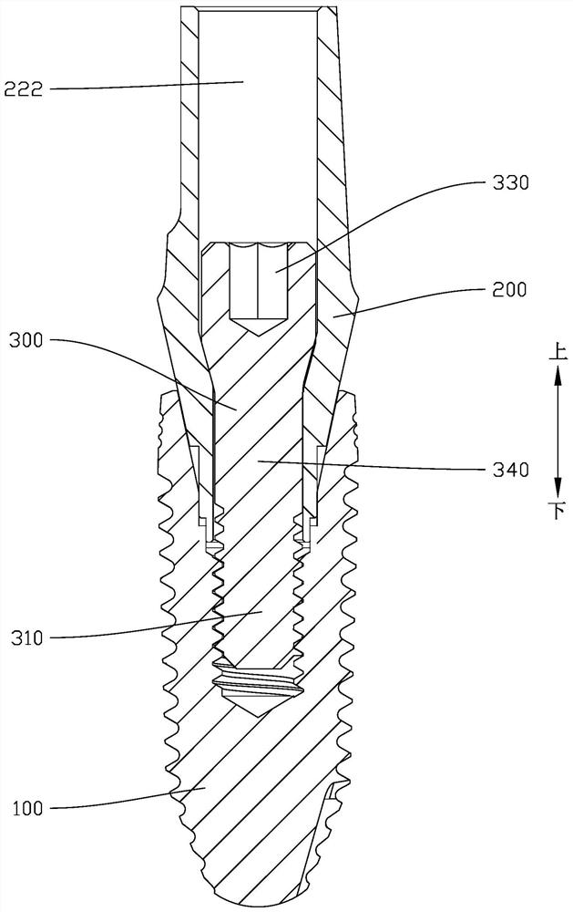 Double-sided fusion connected dental implant assembly