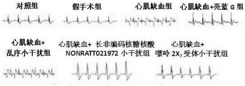 Use of NONRATT021972 small interfering RNA in preparation of drug for treating myocardial ischemia injury and sympathetic nerve diseases