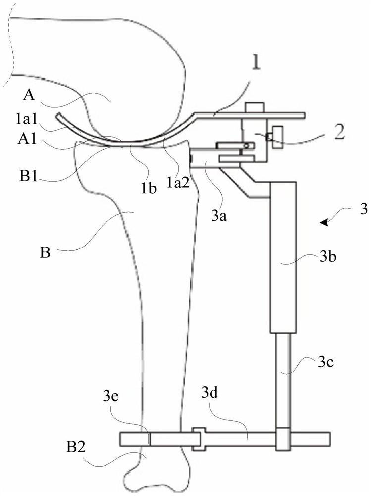 Tibia osteotomy device