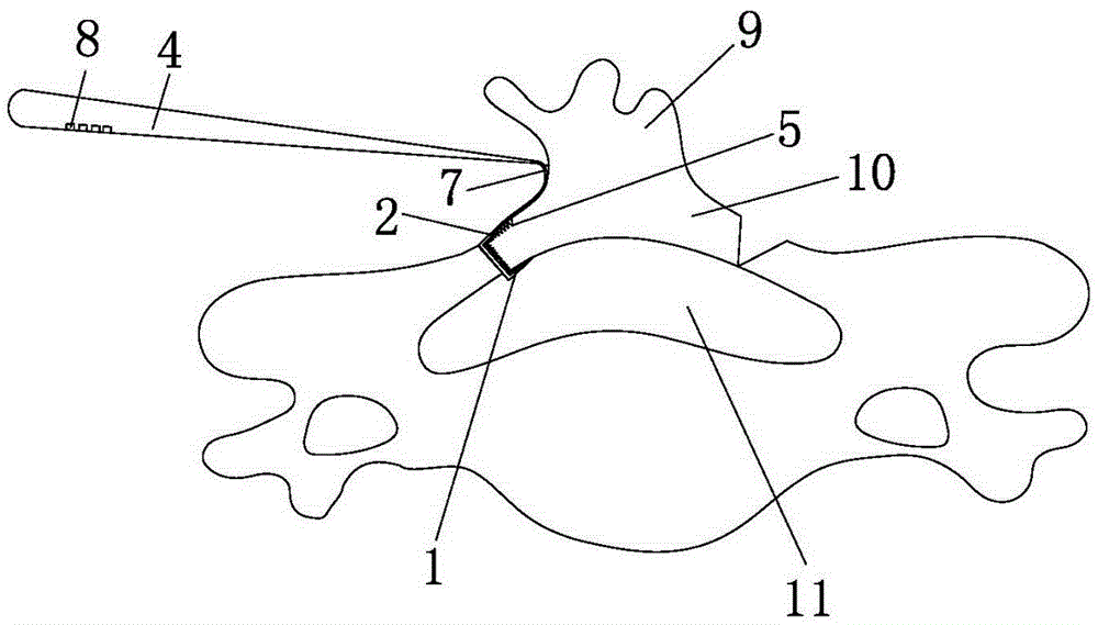 Vertebral plate opener