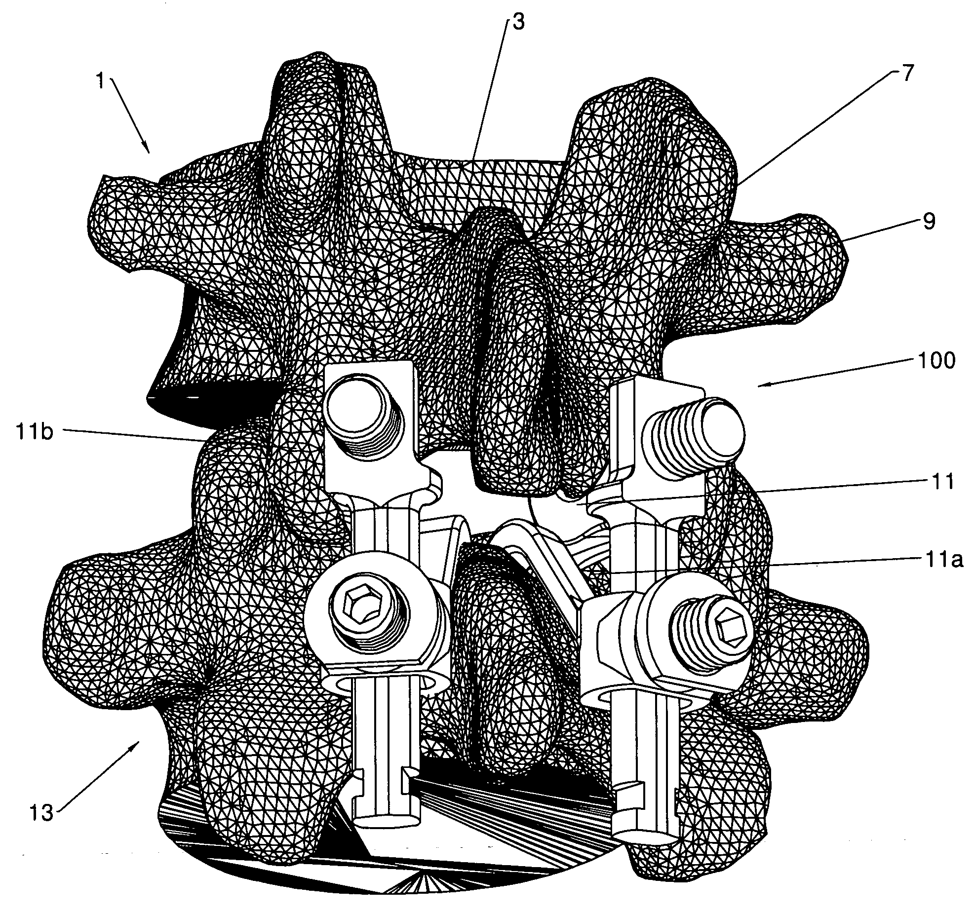 Interlaminar Stabilization System